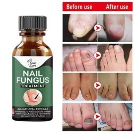 Nail Fungus Treatment Stop Fungal Growth Effective Fingernail 10ml
